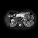 Polyp in jejunum, jejunal polyps, polyposis: MRI - Magnetic Resonance Imaging