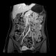 Polyp in jejunum, jejunal polyps, polyposis: MRI - Magnetic Resonance Imaging