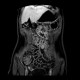 Polyp in jejunum, jejunal polyps, polyposis: MRI - Magnetic Resonance Imaging