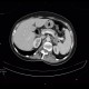 Adrenal metastasis and skeletal metastasis of pulmonary carcinoma, correlation: CT - Computed tomography