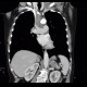 Adrenal metastasis and skeletal metastasis of pulmonary carcinoma, correlation: CT - Computed tomography