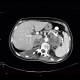 Adrenal metastasis and skeletal metastasis of pulmonary carcinoma, correlation: CT - Computed tomography