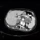 Adrenal metastasis and skeletal metastasis of pulmonary carcinoma, correlation: CT - Computed tomography