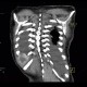 Adrenal metastasis and skeletal metastasis of pulmonary carcinoma, correlation: CT - Computed tomography