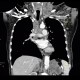 Adrenal metastasis and skeletal metastasis of pulmonary carcinoma, correlation: CT - Computed tomography