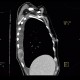 Adrenal metastasis and skeletal metastasis of pulmonary carcinoma, correlation: CT - Computed tomography