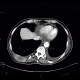 Adrenal metastasis and skeletal metastasis of pulmonary carcinoma, correlation: CT - Computed tomography