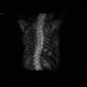 Adrenal metastasis and skeletal metastasis of pulmonary carcinoma, correlation: NM - Nuclear medicine