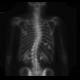 Adrenal metastasis and skeletal metastasis of pulmonary carcinoma, correlation: NM - Nuclear medicine