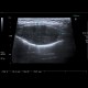 Adrenal metastasis and skeletal metastasis of pulmonary carcinoma, correlation: US - Ultrasound