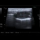Adrenal metastasis and skeletal metastasis of pulmonary carcinoma, correlation: US - Ultrasound