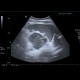 Adrenal metastasis and skeletal metastasis of pulmonary carcinoma, correlation: US - Ultrasound