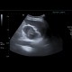 Adrenal metastasis and skeletal metastasis of pulmonary carcinoma, correlation: US - Ultrasound