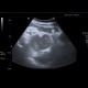 Adrenal metastasis and skeletal metastasis of pulmonary carcinoma, correlation: US - Ultrasound