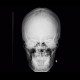 Metopic suture: X-ray - Plain radiograph
