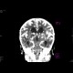 Meningencephalitis, abscessing: CT - Computed tomography