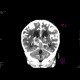 Meningencephalitis, abscessing: CT - Computed tomography