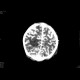 Meningencephalitis, abscessing: CT - Computed tomography