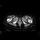 Abscess at the proximal anastomosis of aorto-femoral bypass: CT - Computed tomography