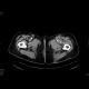Abscess at the proximal anastomosis of aorto-femoral bypass: CT - Computed tomography