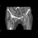 Abscess at the proximal anastomosis of aorto-femoral bypass: CT - Computed tomography