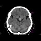 Adenoma of the hypophysis: CT - Computed tomography