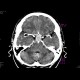 Adenoma of the hypophysis: CT - Computed tomography