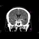 Adenoma of the hypophysis: CT - Computed tomography