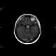Adenoma of the hypophysis: MRI - Magnetic Resonance Imaging