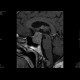 Adenoma of the hypophysis: MRI - Magnetic Resonance Imaging