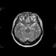 Adenoma of the hypophysis: MRI - Magnetic Resonance Imaging