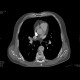 Acute lung embolism: CT - Computed tomography