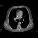 Acute lung embolism: CT - Computed tomography