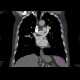 Acute lung embolism: CT - Computed tomography