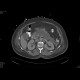 Acute necrosing pancreatitis: CT - Computed tomography
