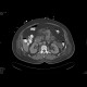 Acute necrosing pancreatitis: CT - Computed tomography