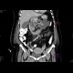 Acute necrosing pancreatitis: CT - Computed tomography