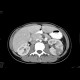 Acute pyelonephritis, left kidney: CT - Computed tomography