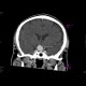Intracranial aneurysm of the internal carotid artery, ICA: CT - Computed tomography