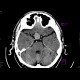 Intracranial aneurysm of the internal carotid artery, ICA: CT - Computed tomography