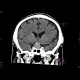 Intracranial aneurysm of the internal carotid artery, ICA: CT - Computed tomography