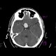 Intracranial aneurysm of the internal carotid artery, ICA: CT - Computed tomography