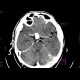 Intracranial aneurysm of the internal carotid artery, ICA: CT - Computed tomography