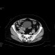 Appendicitis, appendicolith: CT - Computed tomography