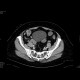Appendicitis, appendicolith: CT - Computed tomography