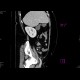 Appendicitis, appendicolith: CT - Computed tomography