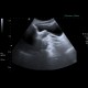 Banana in rectum: US - Ultrasound