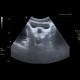 Banana in rectum: US - Ultrasound