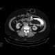 Ventral hernia, herniation of transverse colon: CT - Computed tomography