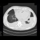 Bronchopneumonia, pleural effusion: CT - Computed tomography